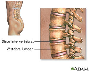 Esquema disco intervertebral